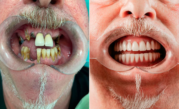 Le faccette in ceramica  nella clinica dentale Grand Turismo Dentale di Chisinau sono le più utilizzate grazie alla resistenza ottimale del materiale, e al fatto non trascurabile che si tratta di restauri adesivi minimamente invasivi.