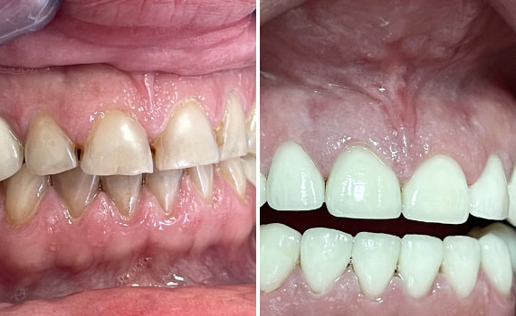 Le faccette in ceramica  nella clinica dentale Grand Turismo Dentale di Chisinau sono le più utilizzate grazie alla resistenza ottimale del materiale, e al fatto non trascurabile che si tratta di restauri adesivi minimamente invasivi.